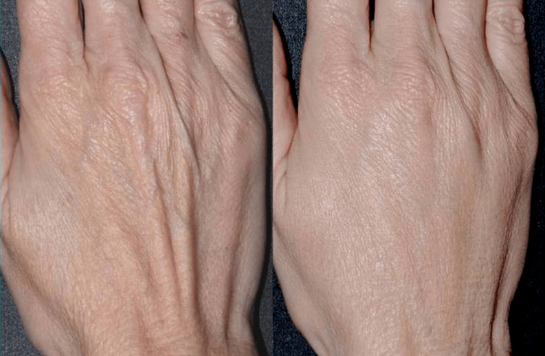 Եզրագծային պլաստիկ, ձեռքի երիտասարդացման լուսանկար 2-ից առաջ և հետո